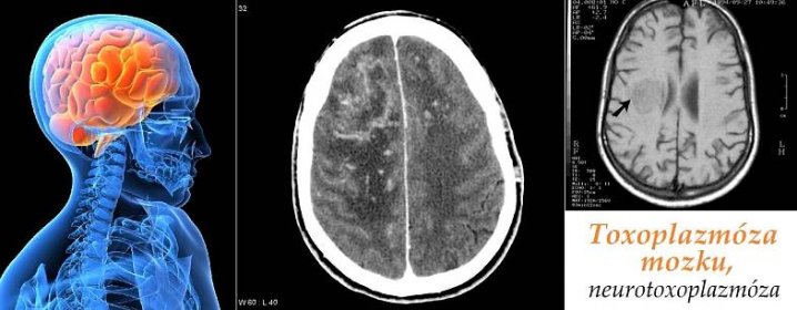 toxoplazmoza mozku mozkova toxoplazmoza priznaky projevy symptomy