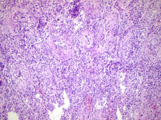 Epididymitis - Wikipedia