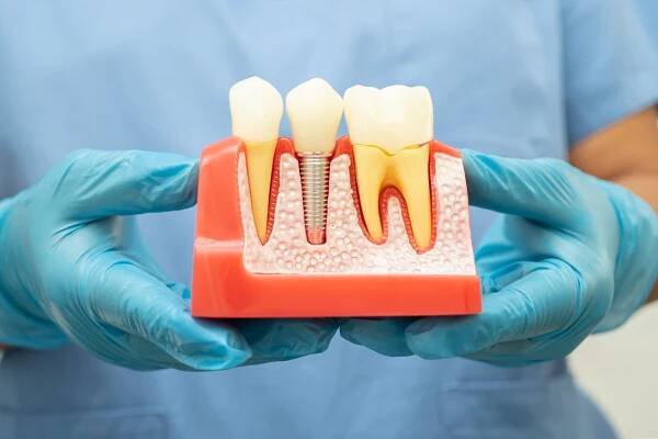 dental-implant-artificial-tooth-roots-into-jaw-r-2024-02-20-02-54-16-utc