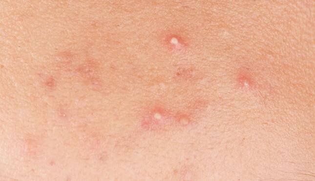 Whiteheads: What They Are, Causes, Treatment & Prevention
