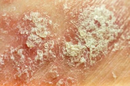Kožní onemocnění pacienta s chronickou dermatózou - lupénka, ekzém, dermatitida. Detailní záběr, měkké ostření, mělká hloubka pole — Stock obrázek