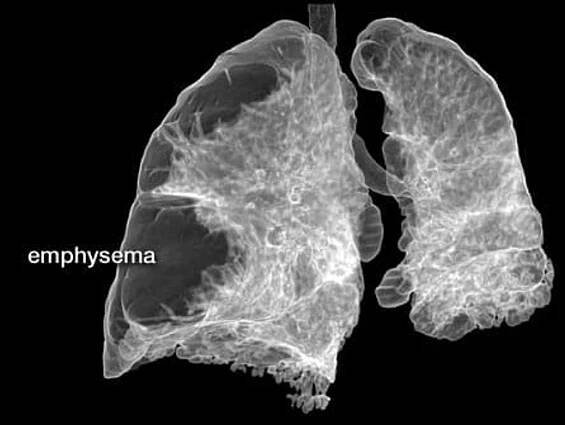 COPD: Emphysema