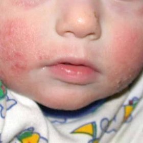Jak vypadají kožní alergie u dětí?