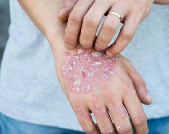psoriáza na rukou člověka