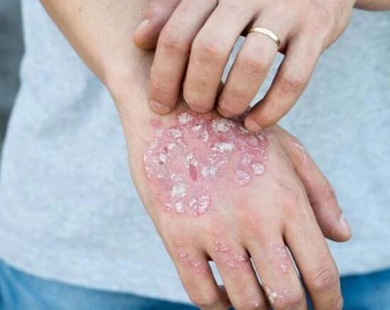 Psoriáza. Suchá a zanícená kůže