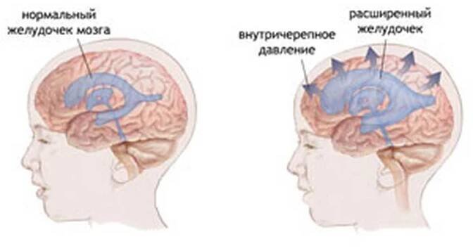 Intrakraniální tlak / Intrakraniální tlak