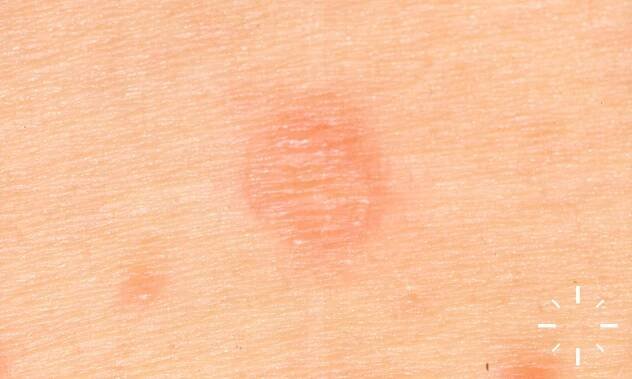DermaCompass - Lymphogranuloma inguinale 