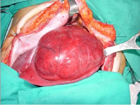Lobectomy