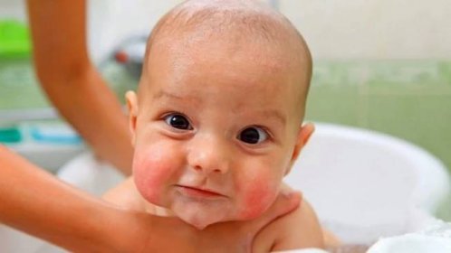 Seboroická dermatitida u kojenců (34 fotografií): léčba pokožky hlavy
