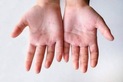 Sedmá dětská nemoc – Syndrom ruce, nohy, ústa