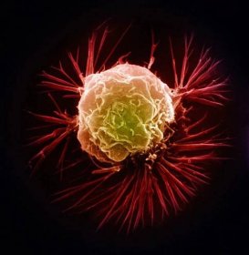 Rakovinu odhalí nový test z kapky krve. Nádory najde i v nejranějším stádiu