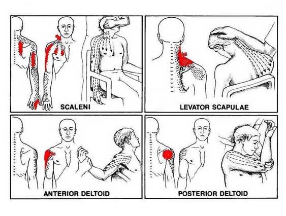 Paul Manley treatment for back and neck pain, Musicians RSI, 8-10 Boston Place, Marylebone, London NW1 6QH 