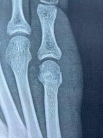 König o léčbě zlomeniny nohy: Myslel jsem si, že to bude prkotina