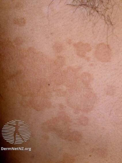 pityriasis versicolor brown