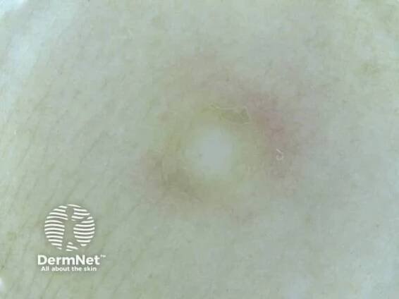 Dermoscopy of dermatofibroma