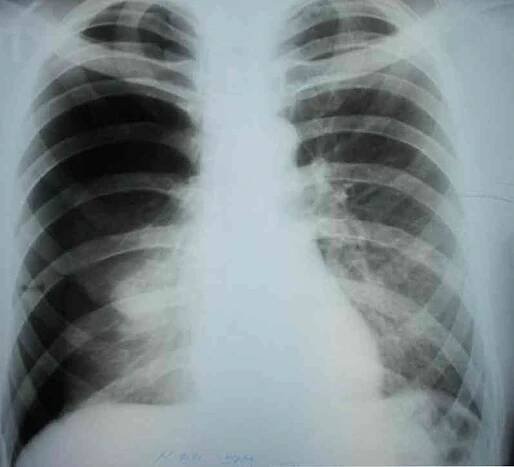 Jak odstranit pneumotorax?