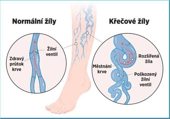 Křečové žíly trápí dvakrát víc ženy než muže: Jak nohy chránit s předstihem a co léčba?