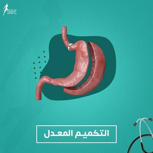 التكميم-المعدل