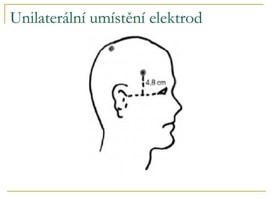 PPT - Elektrokonvulzivní terapie PowerPoint Presentation, free download - ID:3432490