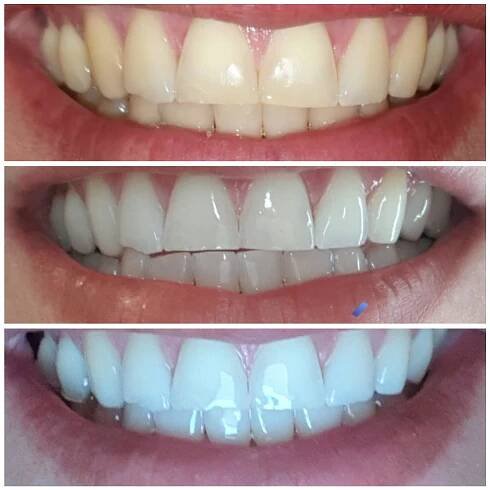 bleaching | Zahnärztin Tatjana Schofer
