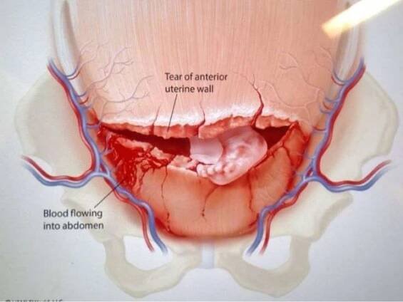 Uterusruptur – Wikipedia