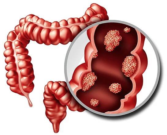50-facts-about-rectal-cancer