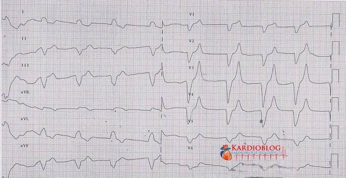 (EKG kazuistika) Hyperkalémie - Kardioblog