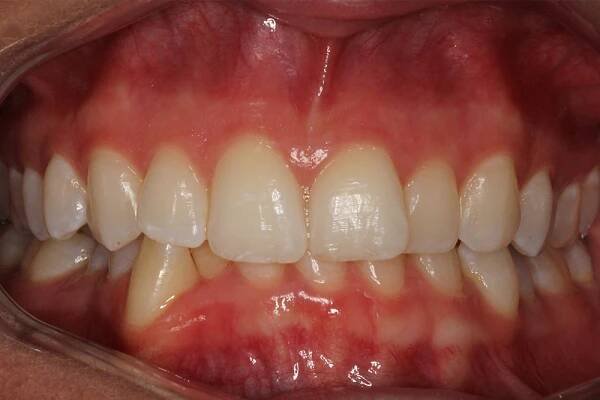 Before and After • 425 Dental