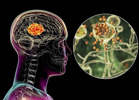 The Mental Health Crisis - Brain Disorders & Mold Toxicity