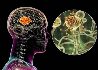 mozková mukormykóza, mozková léze způsobená houbami mucor, také známý jako černá houba, s detailním pohledem na houby, 3d ilustrace - absces trauma - stock snímky, obrázky a fotky