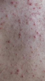 Žena s akné, červené tečky, kožní onemocnění. Kvalitní fotografie — Stock obrázek