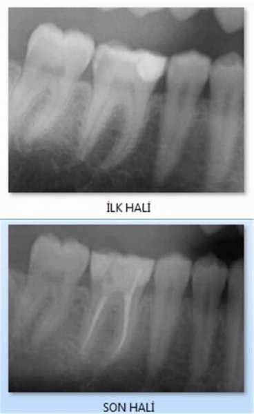 Endodontic Treatments 