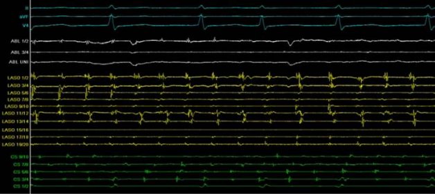 Zobrazovací metody #2 - Katetrová radiofrekvenční ablace - Kardioblog