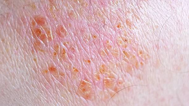 příznak kožní léze u pásového oparu nebo herpes zoster osobně. virové onemocnění virus planých neštovic. bolestivá kožní vyrážka s puchýři na těle. červené pupínky. hmyz kouše. poranění těla. vysoce kvalitní záběry v rozliše - impetigo - stock snímky, obrázky a fotky