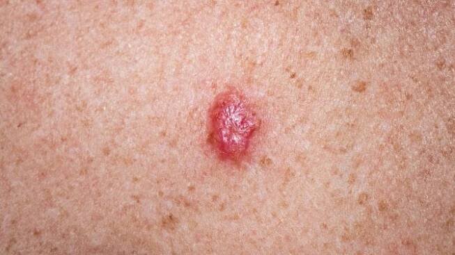 Bazaliom, anglicky basal cell carcinoma