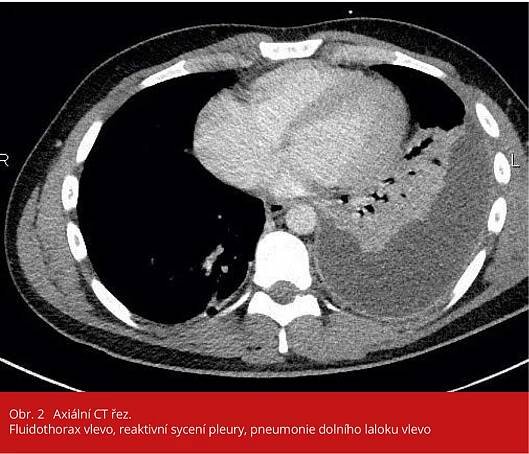 Závažný průběh bakteriemické pneumokokové pneumonie | Zamcasopis.cz