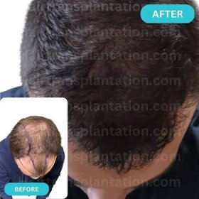 Before and after picture hair transplantation