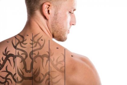 Bezpečnost odstranění tetování – ochrana pokožky a laserové odstranění tetování