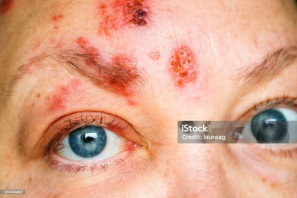 Pásový opar na obličeji a kolem oka, Zvané oftalmologické herpes zoster nebo herpes zoster oftalmáš - Bez autorských poplatků Pásový opar - Nemoc Stock fotka