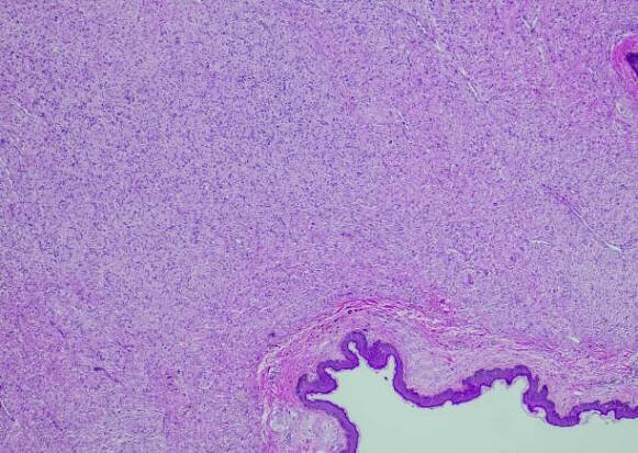 difuzní neurofibrom - neurofibromatóza - stock snímky, obrázky a fotky
