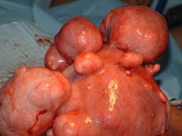 Co je polyp v děloze a její metody léčby 