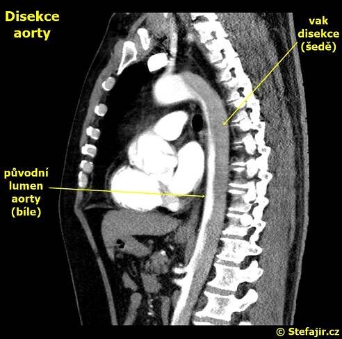 Nález - 37 - Disekce aorty | Medicína, nemoci, studium na 1. LF UK