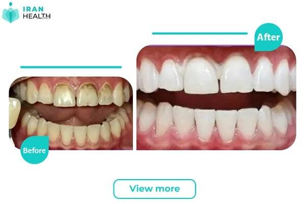 Bleaching BEOFRE AND AFTER PHOTOS