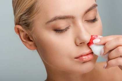 Krvácení z nosu vzniká nejčastěji v důsledku poranění v přední části nosu