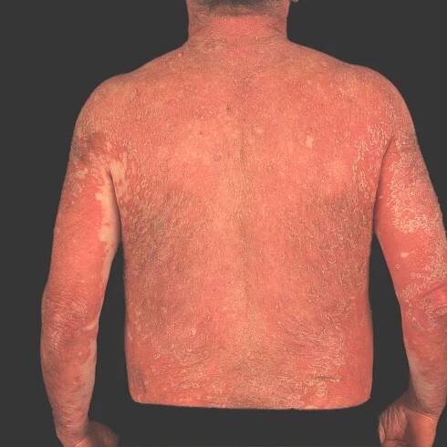 Pityriasis rubra pilaris (adult type)