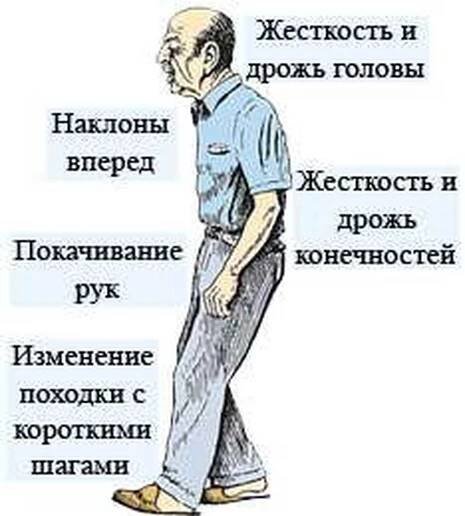 Příčiny, příznaky, stadia, léčba Parkinsonovy nemoci? / Parkinsonova choroba | Užitečné informace a tipy na péči o sebe