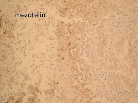 mezotelin

 
