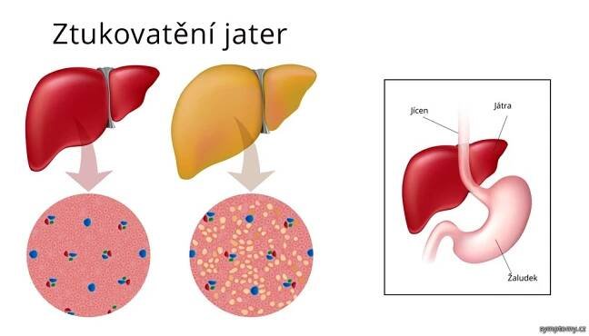 Ztukovatění jater