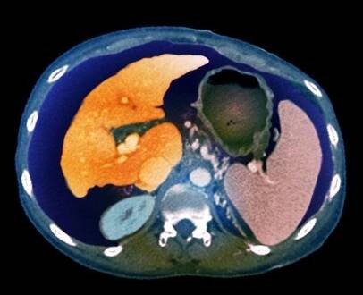 Barevná počítačová tomografie pacienta s hepatitidou C. Nemoc způsobuje cirhózu a atrofii v tkáni jater (světle šedá barva - vlevo).