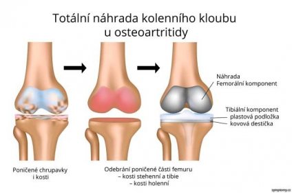 Totální náhrada kolenního kloubu u osteoartritidy